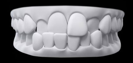 An upper or front tooth