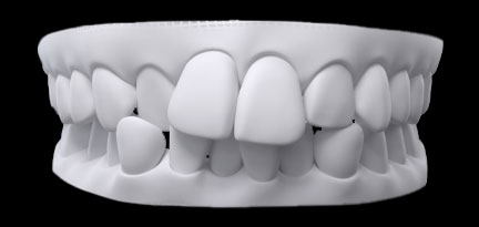 Dental crowding